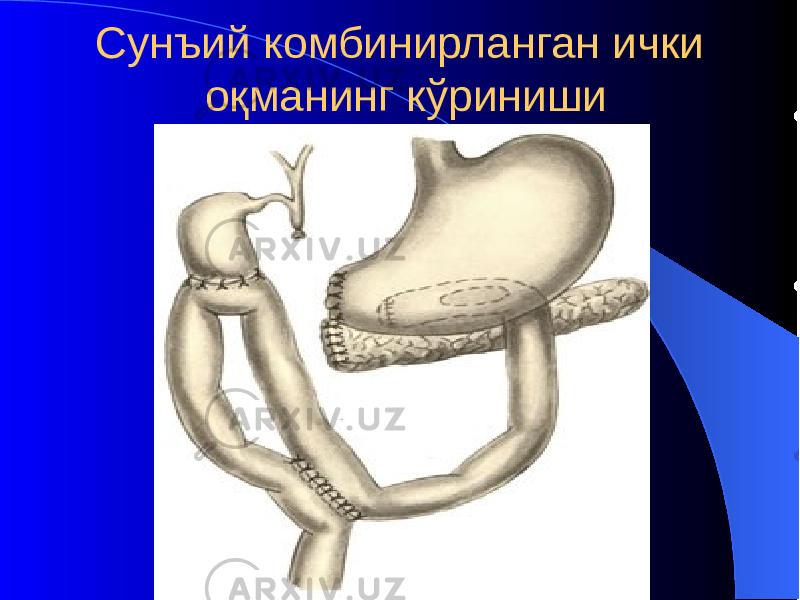 Сунъий комбинирланган ички оқманинг кўриниши 