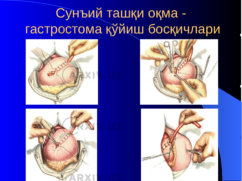 Сунъий ташқи оқма - гастростома қўйиш босқичлари 