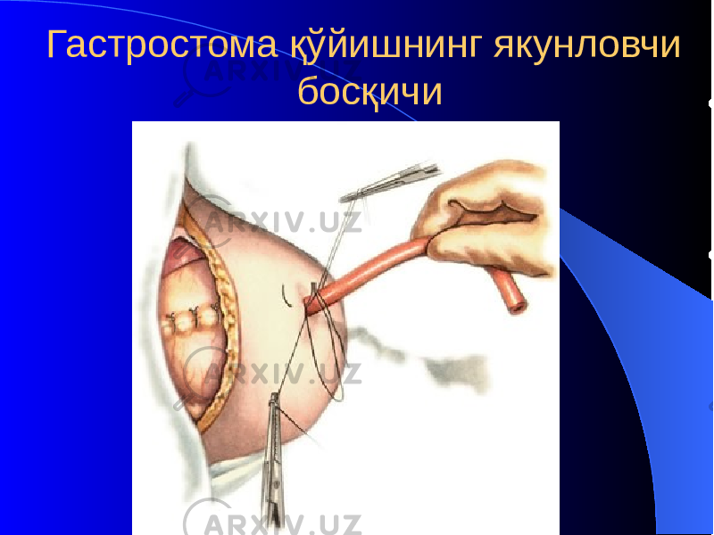 Гастростома қўйишнинг якунловчи босқичи 