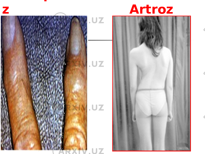 Osteoparo z Artroz 