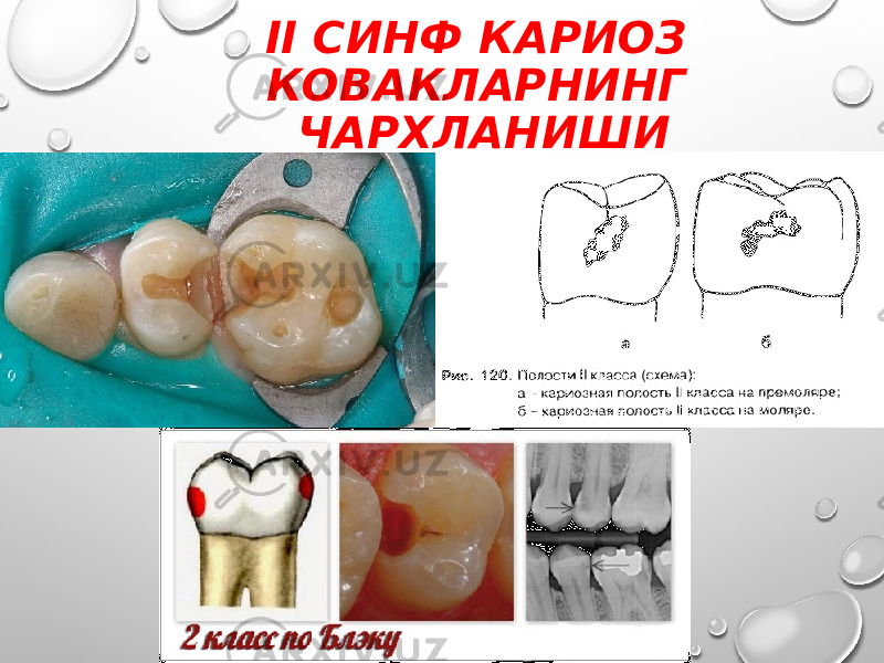 II СИНФ КАРИОЗ КОВАКЛАРНИНГ ЧАРХЛАНИШИ 