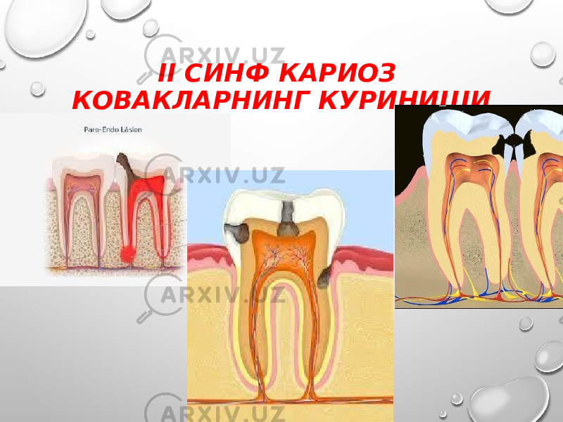 II СИНФ КАРИОЗ КОВАКЛАРНИНГ КУРИНИШИ 