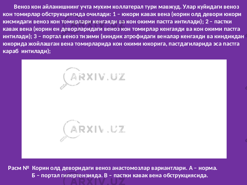  Веноз кон айланишнинг учта мухим коллатерал тури мавжуд. Улар куйидаги веноз кон томирлар обструкциясида очилади: 1 – юкори кавак вена (корин олд девори юкори кисмидаги веноз кон томирлари кенгаяди ва кон окими пастга интилади); 2 – пастки кавак вена (корин ен деворларидаги веноз кон томирлар кенгаяди ва кон окими пастга интилади); 3 – портал веноз тизими (киндик атрофидаги веналар кенгаяди ва киндикдан юкорида жойлашган вена томирларида кон окими юкорига, пастдагиларида эса пастга караб интилади); Расм № Корин олд деворидаги веноз анастомозлар вариантлари. А – норма. Б – портал гипертензияда. В – пастки кавак вена обструкциясида. 