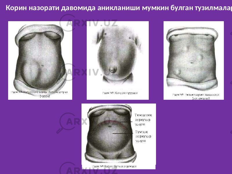 Корин назорати давомида аникланиши мумкин булган тузилмалар Расм № Кориннинг локал йириклашуви (чурра) Расм № Киндик чурраси Расм № Рекленгаузен касаллиги (липоматоз) Расм № Корин бушлиги усмаси Тимпаник перкутор товуш Тумток перкутор товуш 