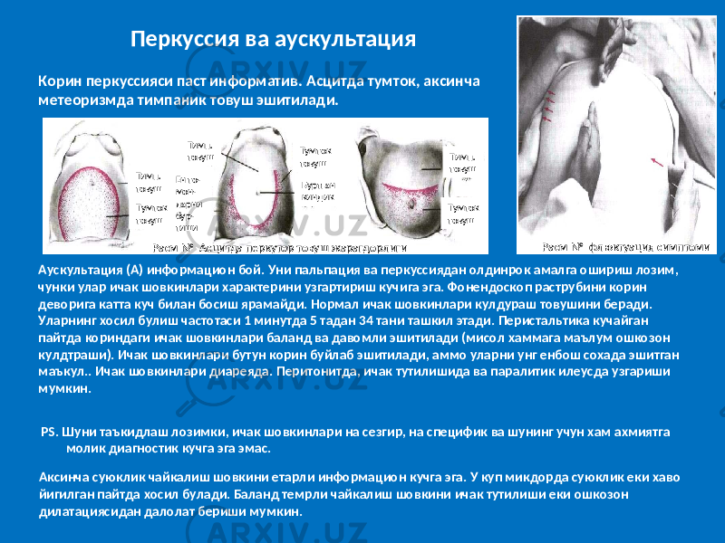  Перкуссия ва аускультация Корин перкуссияси паст информатив. Асцитда тумток, аксинча метеоризмда тимпаник товуш эшитилади. Аускультация (А) информацион бой. Уни пальпация ва перкуссиядан олдинрок амалга ошириш лозим, чунки улар ичак шовкинлари характерини узгартириш кучига эга. Фонендоскоп раструбини корин деворига катта куч билан босиш ярамайди. Нормал ичак шовкинлари кулдураш товушини беради. Уларнинг хосил булиш частотаси 1 минутда 5 тадан 34 тани ташкил этади. Перистальтика кучайган пайтда кориндаги ичак шовкинлари баланд ва давомли эшитилади (мисол хаммага маълум ошкозон кулдтраши). Ичак шовкинлари бутун корин буйлаб эшитилади, аммо уларни унг енбош сохада эшитган маъкул.. Ичак шовкинлари диареяда. Перитонитда, ичак тутилишида ва паралитик илеусда узгариши мумкин. PS. Шуни таъкидлаш лозимки, ичак шовкинлари на сезгир, на специфик ва шунинг учун хам ахмиятга молик диагностик кучга эга эмас. Аксинча суюклик чайкалиш шовкини етарли информацион кучга эга. У куп микдорда суюклик еки хаво йигилган пайтда хосил булади. Баланд темрли чайкалиш шовкини ичак тутилиши еки ошкозон дилатациясидан далолат бериши мумкин. Расм № флюктуация симптоми Расм № Асцитда перкутор товуш жарагдорлигиТимп. товуш Тумток товуш Ен то- мон- ларни бур- тиши Тимп. товуш Тумток товуш Буртган киндик Тимп. товуш Тумток товуш 