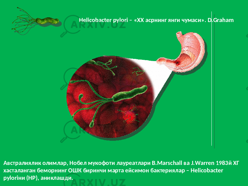 Helicobacter pyl о ri – «XX асрнинг янги чумаси». D.Graham Австралиялик олимлар, Нобел мукофоти лауреатлари B.Marschall ва J.Warren 1983й ХГ хасталанган беморнинг ОШК биринчи марта ейсимон бактериялар – Нelicobacter pylоriни (НР), аниклашди. 