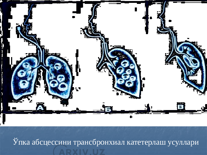 Ўпка абсцессини трансбронхиал катетерлаш усуллари 