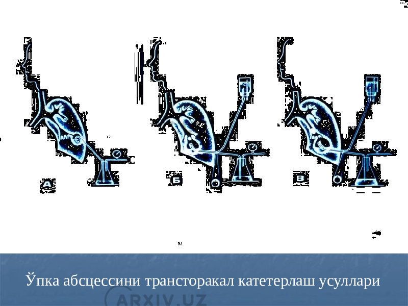 Ўпка абсцессини трансторакал катетерлаш усуллари 