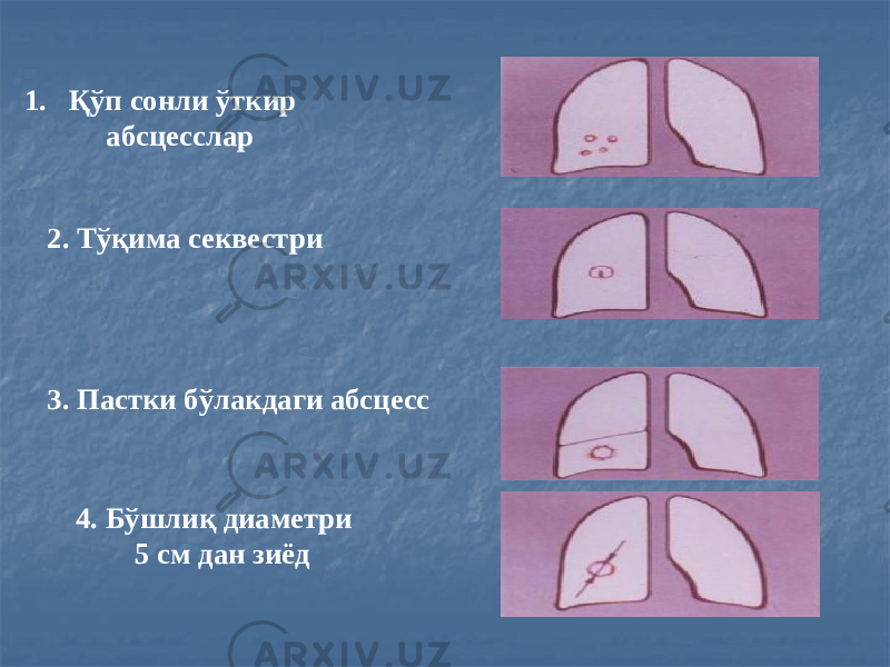 1. Қўп сонли ўткир абсцесслар 2. Тўқима секвестри 3. Пастки бўлакдаги абсцесс 4. Бўшлиқ диаметри 5 см дан зиёд 