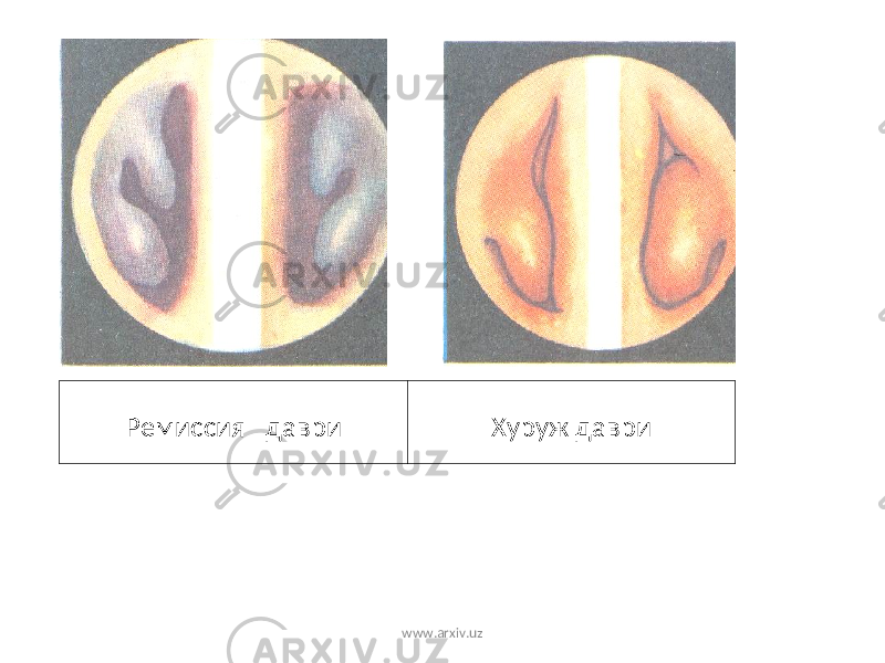 Ремиссия даври Хуруж даври www.arxiv.uz 