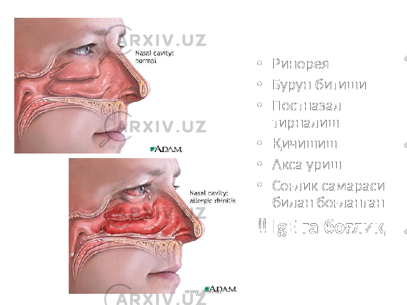 • Ринорея • Бурун битиши • Постназал тирналиш • Қичишиш • Акса уриш • Соғлик самараси билан боғланган ‼ IgE га боғлиқ www.arxiv.uz 