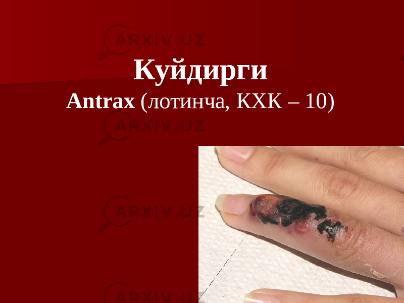 38Куйдирги Antrax (лотинча, КХК – 10) 