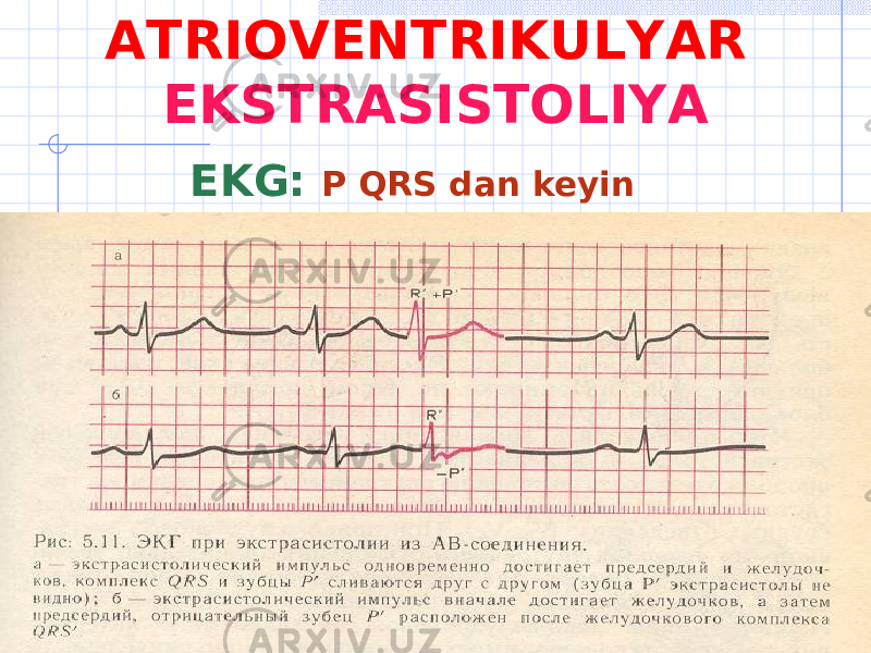 А TRIOVENTRIKULYAR EKSTRASISTOLIYA EKG: Р QRS dan keyin 