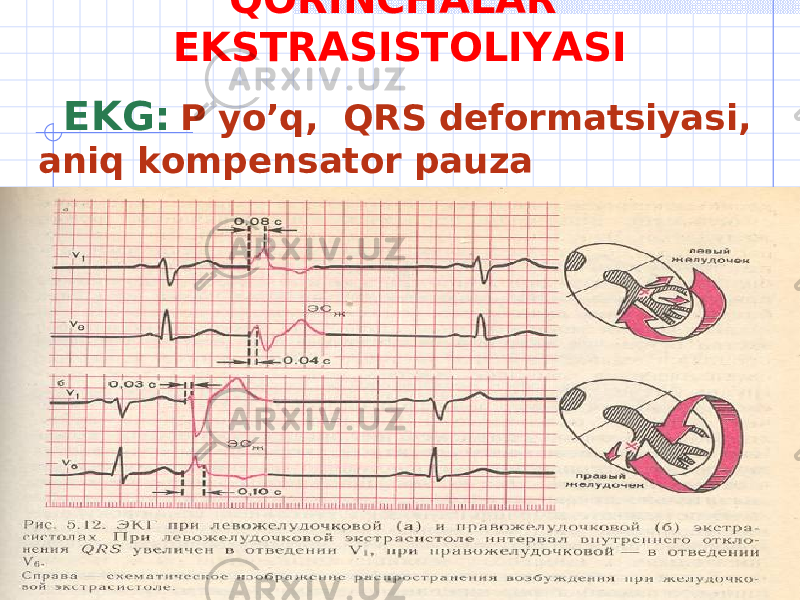 QORINCHALAR EKSTRASISTOLIYASI EKG : Р yo’q , QRS deformatsiyasi , aniq kompensator pauza 