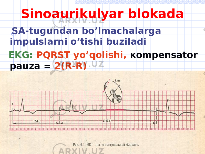 Sinoaurikulyar blokada SA-tugundan bo’lmachalarga impulslarni o’tishi buziladi EKG : PQRST yo’qolishi , ко mpensator pauza = 2( R-R ) 