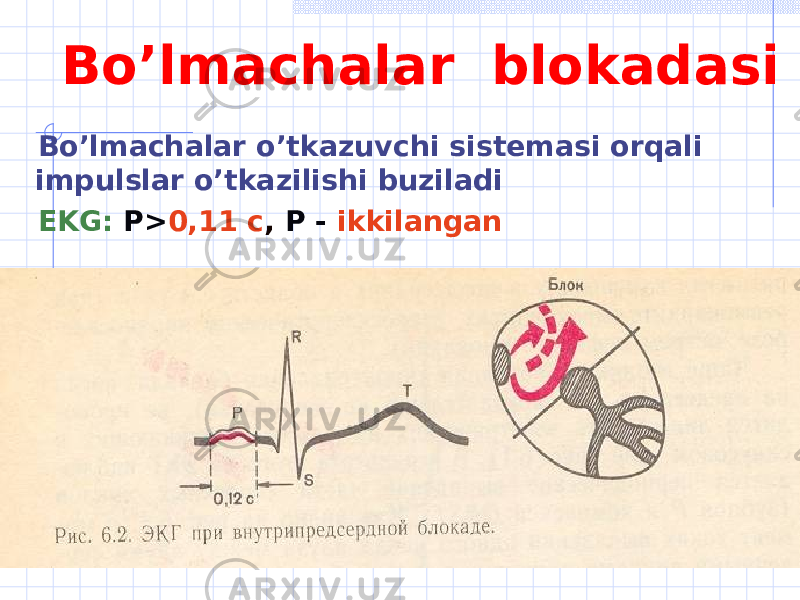 Bo’lmachalar blokadasi Bo’lmachalar o’tkazuvchi sistemasi orqali impulslar o’tkazilishi buziladi EKG : Р> 0,11 с , Р - ikkilangan 