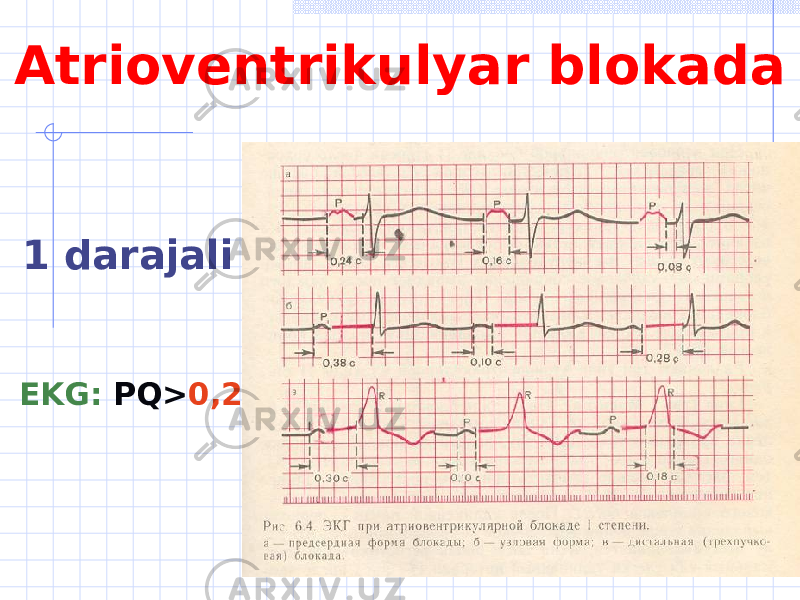  1 darajali EKG : PQ > 0,2 сAtrioventrikulyar blokada 