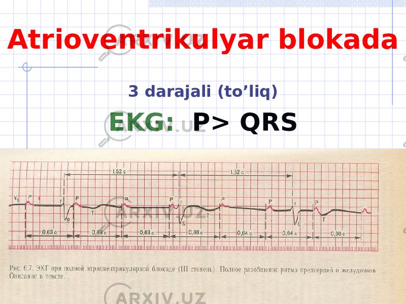 Atrioventrikulyar blokada 3 darajali ( to’liq ) EKG : Р> QRS 