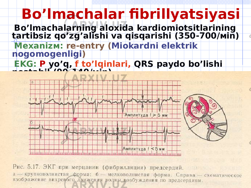 Bo’lmachalar fibrillyatsiyasi Bo’lmachalarning aloxida kardiomiotsitlarining tartibsiz qo’zg’alishi va qisqarishi (350-700 / м in ) Меха niz м: re-entry ( Miokardni elektrik nogomogenligi ) EKG : Р yo’q , f to’lqinlari , QRS paydo bo’lishi nostabil (90-140 / м in ) 