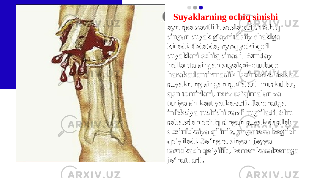 Suyaklarning ochiq sinishi ayniqsa xavfli hisoblanadi. Ochiq singan suyak g&#39;ayritabiiy shaklga kiradi. Odatda, oyoq yoki qo‘l suyaklari ochiq sinadi. Bunday hollarda singan suyakni mutlaqo harakatlantirmaslik lozim. Aks holda, suyakning singan qirralari muskullar, qon tomirlari, nerv to‘qimalan va teriga shikast yetkazadi. Jarohatga infeksiya tushishi xavfi tug‘iladi. Shu sababdan ochiq singan suyak dastlab dezinfeksiya qilinib, unga toza bog&#39;ich qo&#39;yiladi. So‘ngra singan joyga taxtakach qo‘yilib, bemor kasalxonaga jo‘natiladi. 