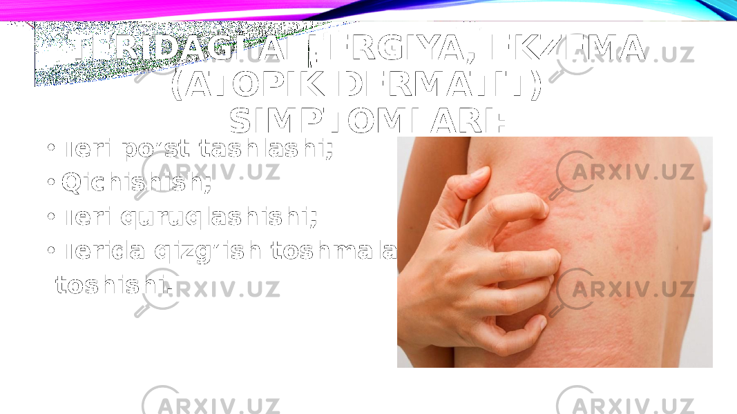 TERIDAGI ALLERGIYA, EKZEMA (ATOPIK DERMATIT) SIMPTOMLARI: • Teri po’st tashlashi; • Qichishish; • Teri quruqlashishi; • Terida qizg’ish toshmalar toshishi. 