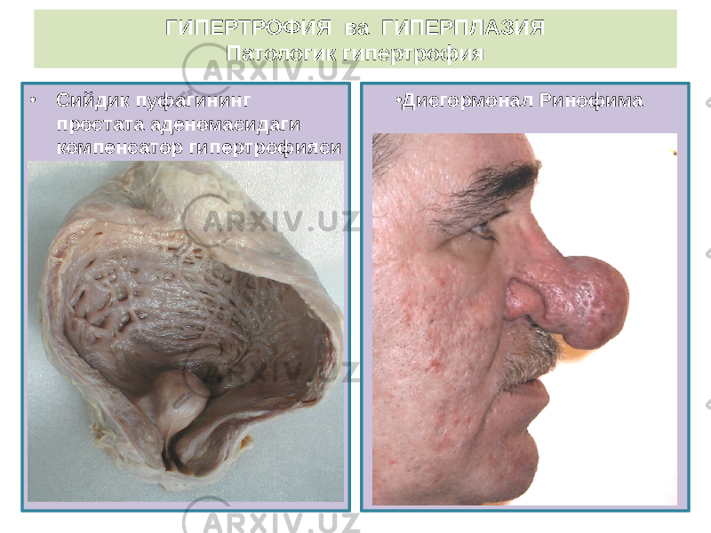 • Сийдик пуфагининг простата аденомасидаги компенсатор гипертрофияси • Дисгормонал РинофимаГИПЕРТРОФИЯ ва ГИПЕРПЛАЗИЯ Патологик гипертрофия 