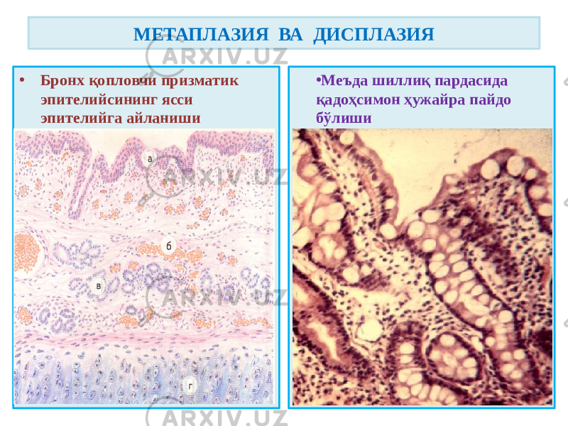 • Бронх қопловчи призматик эпителийсининг ясси эпителийга айланиши • Меъда шиллиқ пардасида қадоҳсимон ҳужайра пайдо бўлишиМЕТАПЛАЗИЯ ВА ДИСПЛАЗИЯ 
