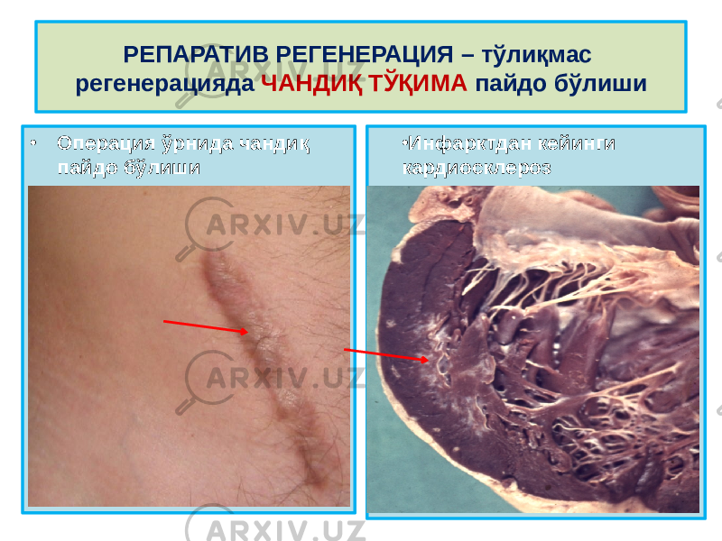 • Операция ўрнида чандиқ пайдо бўлиши • Инфарктдан кейинги кардиосклерозРЕПАРАТИВ РЕГЕНЕРАЦИЯ – тўлиқмас регенерацияда ЧАНДИҚ ТЎҚИМА пайдо бўлиши 