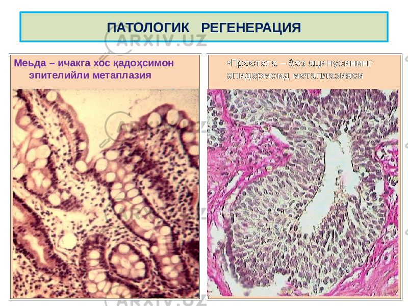 Меьда – ичакга хос қадоҳсимон эпителийли метаплазия • Простата – без ацинусининг эпидермоид метаплазиясиПАТОЛОГИК РЕГЕНЕРАЦИЯ 