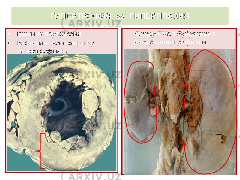 • Ишчи гипертрофия • Юракнинг компенсатор гипертрофияси • Викар Г.Чап буйракнинг викар гипертрофиясиГИПЕРТРОФИЯ ва ГИПЕРПЛАЗИЯ 
