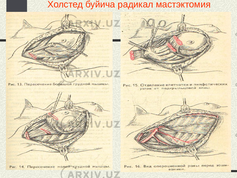 Холстед буйича радикал мастэктомия 