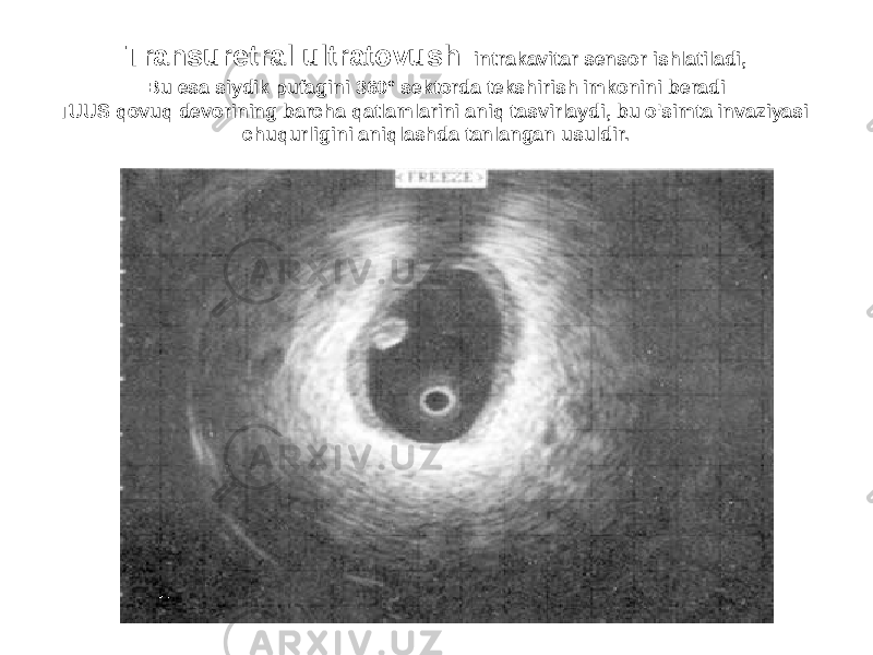 Transuretral ultratovush intrakavitar sensor ishlatiladi, Bu esa siydik pufagini 360° sektorda tekshirish imkonini beradi TUUS qovuq devorining barcha qatlamlarini aniq tasvirlaydi, bu o&#39;simta invaziyasi chuqurligini aniqlashda tanlangan usuldir. 