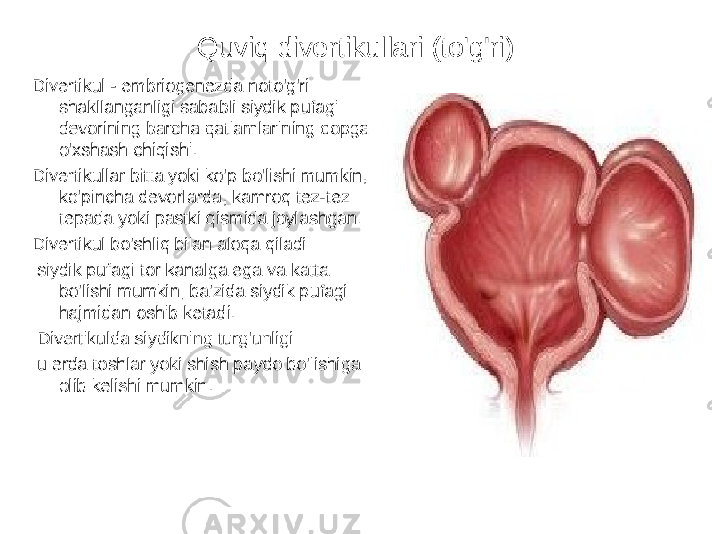 Quviq divertikullari (to&#39;g&#39;ri) Divertikul - embriogenezda noto&#39;g&#39;ri shakllanganligi sababli siydik pufagi devorining barcha qatlamlarining qopga o&#39;xshash chiqishi. Divertikullar bitta yoki ko&#39;p bo&#39;lishi mumkin, ko&#39;pincha devorlarda, kamroq tez-tez tepada yoki pastki qismida joylashgan. Divertikul bo&#39;shliq bilan aloqa qiladi siydik pufagi tor kanalga ega va katta bo&#39;lishi mumkin, ba&#39;zida siydik pufagi hajmidan oshib ketadi. Divertikulda siydikning turg&#39;unligi u erda toshlar yoki shish paydo bo&#39;lishiga olib kelishi mumkin. 