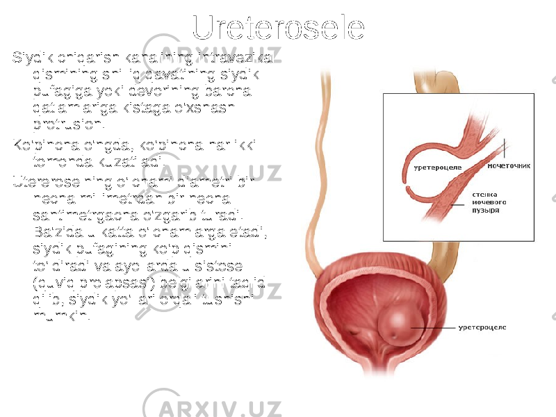 Ureterosele Siydik chiqarish kanalining intravezikal qismining shilliq qavatining siydik pufagiga yoki devorining barcha qatlamlariga kistaga o&#39;xshash protrusion. Ko&#39;pincha o&#39;ngda, ko&#39;pincha har ikki tomonda kuzatiladi. Utereroselning o&#39;lchami diametri bir necha millimetrdan bir necha santimetrgacha o&#39;zgarib turadi. Ba&#39;zida u katta o&#39;lchamlarga etadi, siydik pufagining ko&#39;p qismini to&#39;ldiradi va ayollarda u sistosel (quviq prolapsasi) belgilarini taqlid qilib, siydik yo&#39;llari orqali tushishi mumkin. 