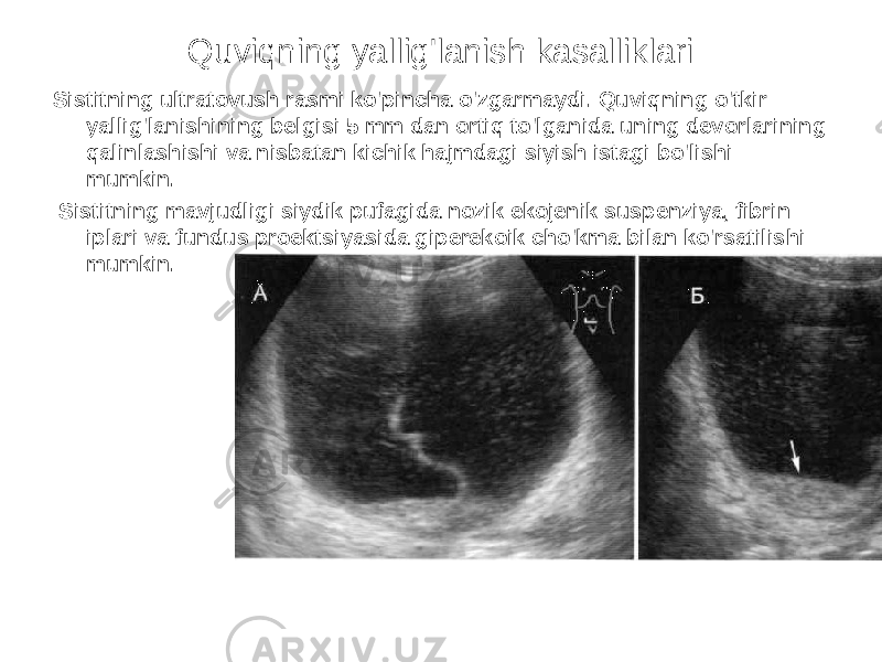 Quviqning yallig&#39;lanish kasalliklari Sistitning ultratovush rasmi ko&#39;pincha o&#39;zgarmaydi. Quviqning o&#39;tkir yallig&#39;lanishining belgisi 5 mm dan ortiq to&#39;lganida uning devorlarining qalinlashishi va nisbatan kichik hajmdagi siyish istagi bo&#39;lishi mumkin. Sistitning mavjudligi siydik pufagida nozik ekojenik suspenziya, fibrin iplari va fundus proektsiyasida giperekoik cho&#39;kma bilan ko&#39;rsatilishi mumkin. 