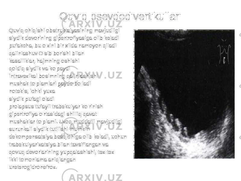 Quviq psevdodivertikullari Quviq chiqishi obstruktsiyasining mavjudligi siydik devorining gipertrofiyasiga olib keladi pufakcha, bu o&#39;zini bir xilda namoyon qiladi qalinlashuv O&#39;sib borishi bilan kasalliklar, hajmning oshishi qoldiq siydik va ko&#39;paydi intravezikal bosimning qalinlashishi mushak to&#39;plamlari paydo bo&#39;ladi notekis, ichki yuza siydik pufagi oladi prolapsus tufayli trabekulyar ko&#39;rinish gipertrofiya o&#39;rtasidagi shilliq qavat mushaklar to&#39;plami. Uzoq muddatli mavjudligi surunkali siydik tutilishi mumkin dekompensatsiya bosqichiga olib keladi, uchun trabekulyarizatsiya bilan tavsiflangan va qovuq devorlarining yupqalashishi, tez-tez ikki tomonlama aniqlangan ureterogidronefroz. 