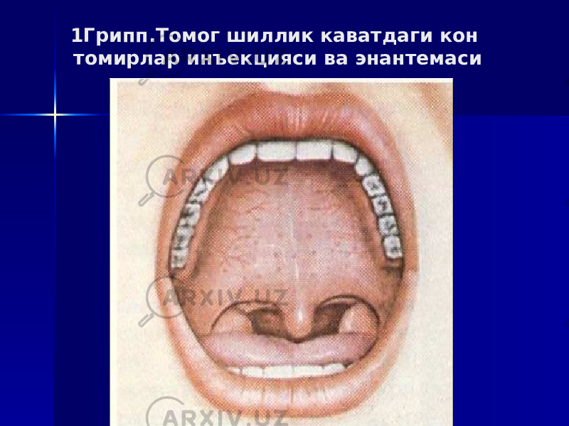 1Грипп.Томог шиллик каватдаги кон томирлар инъекцияси ва энантемаси 