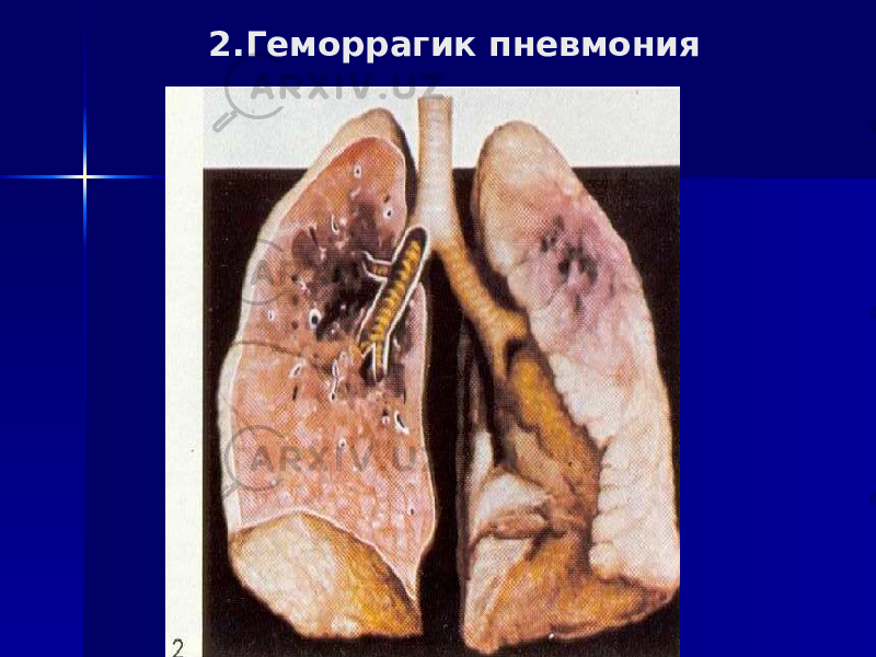 2.Геморрагик пневмония 