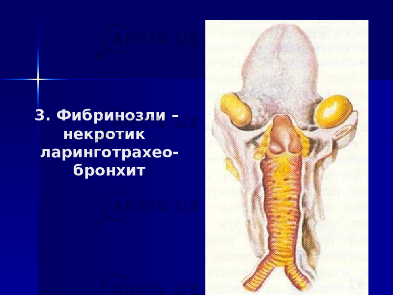 3. Фибринозли – некротик ларинготрахео- бронхит 