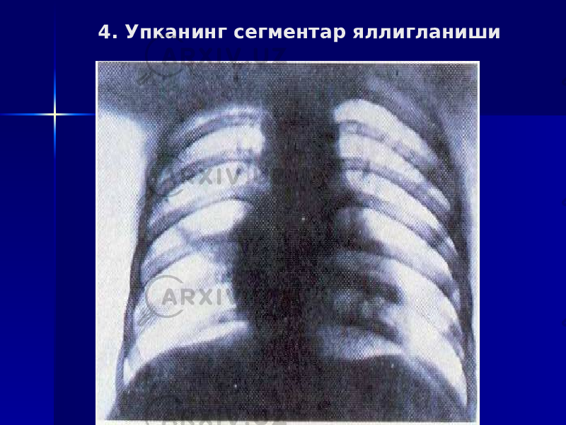 4. Упканинг сегментар яллигланиши 