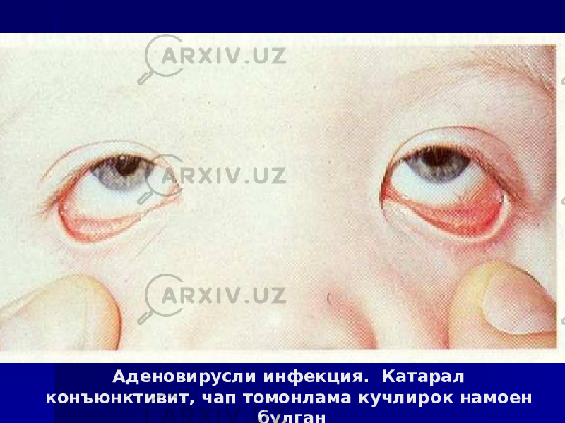 Аденовирусли инфекция. Катарал конъюнктивит, чап томонлама кучлирок намоен булган 
