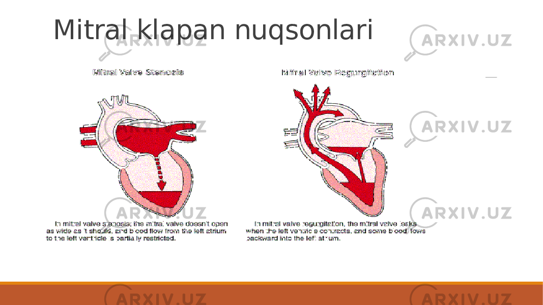 Mitral klapan nuqsonlari 