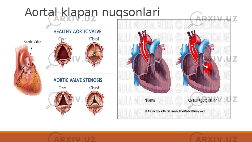 Aortal klapan nuqsonlari 