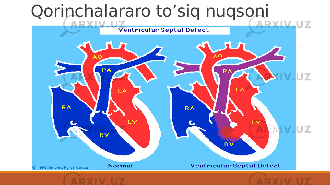 Qorinchalararo to’siq nuqsoni 