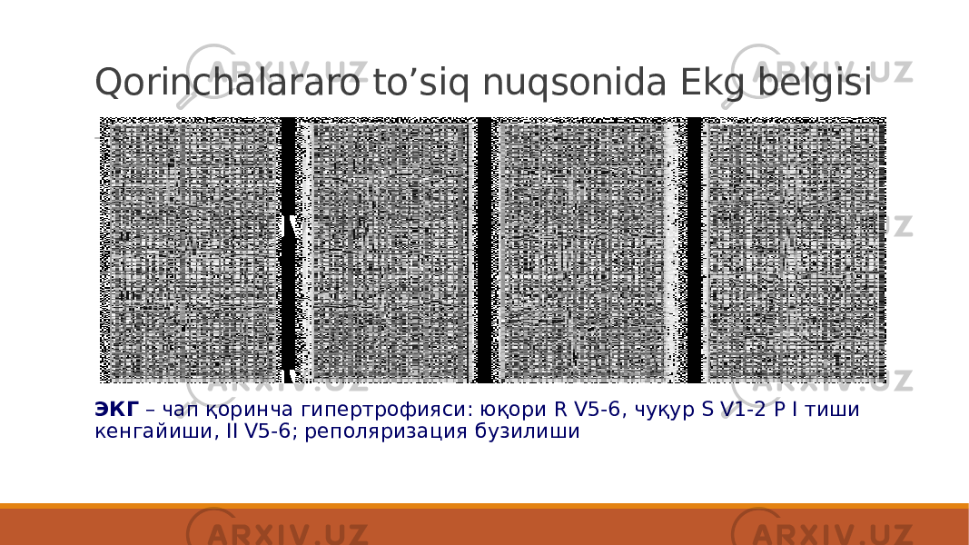 Qorinchalararo to’siq nuqsonida Ekg belgisi ЭКГ – чап қоринча гипертрофияси: юқори R V5-6, чуқур S V1-2 Р I тиши кенгайиши, II V5-6; реполяризация бузилиши 