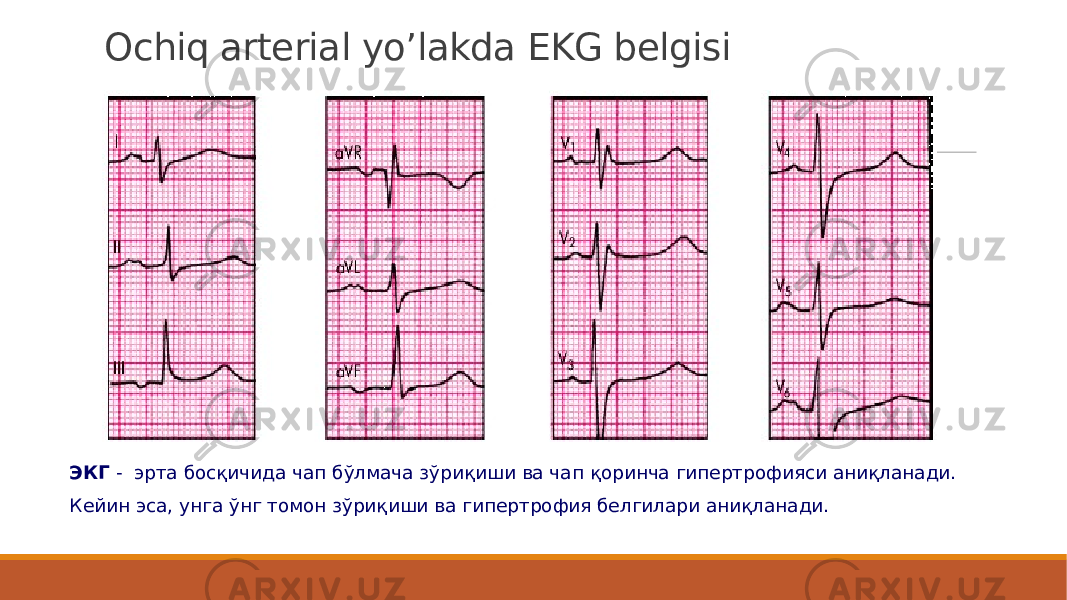 Ochiq arterial yo’lakda EKG belgisi ЭКГ -  эрта босқичида чап бўлмача зўриқиши ва чап қоринча гипертрофияси аниқланади. Кейин эса, унга ўнг томон зўриқиши ва гипертрофия белгилари аниқланади. 