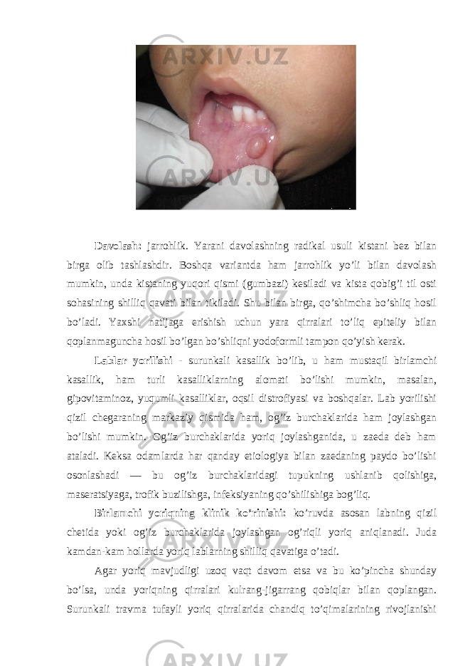  Davolash: jarrohlik. Yarani davolashning radikal usuli kistani bez bilan birga olib tashlashdir. Boshqa variantda ham jarrohlik yo’li bilan davolash mumkin, unda kistaning yuqori qismi (gumbazi) kesiladi va kista qobig’i til osti sohasining shilliq qavati bilan tikiladi. Shu bilan birga, qo’shimcha bo’shliq hosil bo’ladi. Yaxshi natijaga erishish uchun yara qirralari to’liq epiteliy bilan qoplanmaguncha hosil bo’lgan bo’shliqni yodoformli tampon qo’yish kerak. Lablar yorilishi - surunkali kasallik bo’lib, u ham mustaqil birlamchi kasallik, ham turli kasalliklarning alomati bo’lishi mumkin, masalan, gipovitaminoz, yuqumli kasalliklar, oqsil distrofiyasi va boshqalar. Lab yorilishi qizil chegaraning markaziy qismida ham, og’iz burchaklarida ham joylashgan bo’lishi mumkin. Og’iz burchaklarida yoriq joylashganida, u zaeda deb ham ataladi. Keksa odamlarda har qanday etiologiya bilan zaedaning paydo bo’lishi osonlashadi — bu og’iz burchaklaridagi tupukning ushlanib qolishiga, maseratsiyaga, trofik buzilishga, infeksiyaning qo’shilishiga bog’liq. Birlamchi yoriqning klinik ko’rinishi: ko’ruvda asosan labning qizil chetida yoki og’iz burchaklarida joylashgan og’riqli yoriq aniqlanadi. Juda kamdan-kam hollarda yoriq lablarning shilliq qavatiga o’tadi. Agar yoriq mavjudligi uzoq vaqt davom etsa va bu ko’pincha shunday bo’lsa, unda yoriqning qirralari kulrang-jigarrang qobiqlar bilan qoplangan. Surunkali travma tufayli yoriq qirralarida chandiq to’qimalarining rivojlanishi 