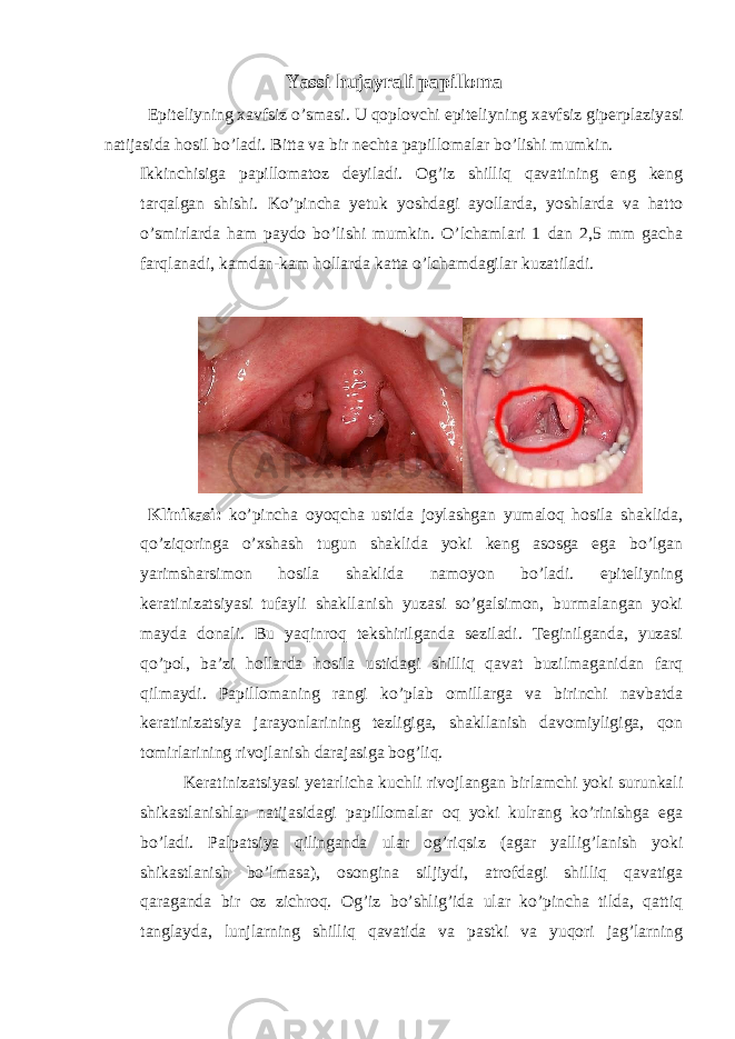 Yassi hujayrali papilloma Epiteliyning xavfsiz o’smasi. U qoplovchi epiteliyning xavfsiz giperplaziyasi natijasida hosil bo’ladi. Bitta va bir nechta papillomalar bo’lishi mumkin. Ikkinchisiga papillomatoz deyiladi. Og’iz shilliq qavatining eng keng tarqalgan shishi. Ko’pincha yetuk yoshdagi ayollarda, yoshlarda va hatto o’smirlarda ham paydo bo’lishi mumkin. O’lchamlari 1 dan 2,5 mm gacha farqlanadi, kamdan-kam hollarda katta o’lchamdagilar kuzatiladi. Klinikasi: ko’pincha oyoqcha ustida joylashgan yumaloq hosila shaklida, qo’ziqoringa o’xshash tugun shaklida yoki keng asosga ega bo’lgan yarimsharsimon hosila shaklida namoyon bo’ladi. epiteliyning keratinizatsiyasi tufayli shakllanish yuzasi so’galsimon, burmalangan yoki mayda donali. Bu yaqinroq tekshirilganda seziladi. Teginilganda, yuzasi qo’pol, ba’zi hollarda hosila ustidagi shilliq qavat buzilmaganidan farq qilmaydi. Papillomaning rangi ko’plab omillarga va birinchi navbatda keratinizatsiya jarayonlarining tezligiga, shakllanish davomiyligiga, qon tomirlarining rivojlanish darajasiga bog’liq. Keratinizatsiyasi yetarlicha kuchli rivojlangan birlamchi yoki surunkali shikastlanishlar natijasidagi papillomalar oq yoki kulrang ko’rinishga ega bo’ladi. Palpatsiya qilinganda ular og’riqsiz (agar yallig’lanish yoki shikastlanish bo’lmasa), osongina siljiydi, atrofdagi shilliq qavatiga qaraganda bir oz zichroq. Og’iz bo’shlig’ida ular ko’pincha tilda, qattiq tanglayda, lunjlarning shilliq qavatida va pastki va yuqori jag’larning 