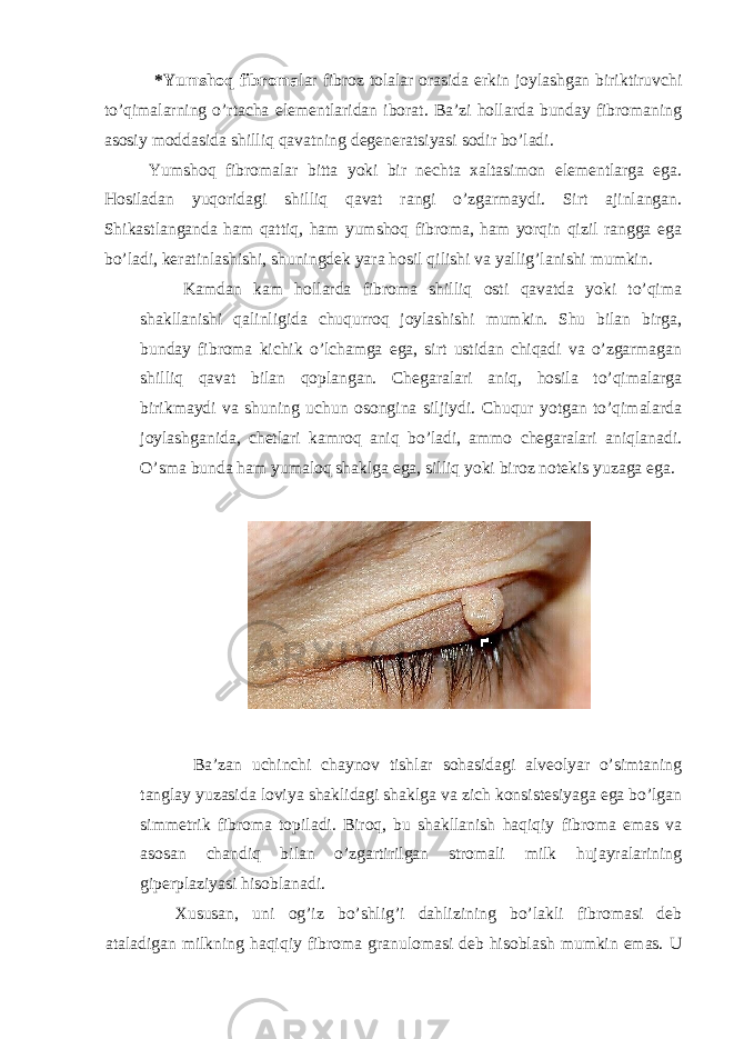  *Yumshoq fibroma lar fibroz tolalar orasida erkin joylashgan biriktiruvchi to’qimalarning o’rtacha elementlaridan iborat. Ba’zi hollarda bunday fibromaning asosiy moddasida shilliq qavatning degeneratsiyasi sodir bo’ladi. Yumshoq fibromalar bitta yoki bir nechta xaltasimon elementlarga ega. Hosiladan yuqoridagi shilliq qavat rangi o’zgarmaydi. Sirt ajinlangan. Shikastlanganda ham qattiq, ham yumshoq fibroma, ham yorqin qizil rangga ega bo’ladi, keratinlashishi, shuningdek yara hosil qilishi va yallig’lanishi mumkin. Kamdan kam hollarda fibroma shilliq osti qavatda yoki to’qima shakllanishi qalinligida chuqurroq joylashishi mumkin. Shu bilan birga, bunday fibroma kichik o’lchamga ega, sirt ustidan chiqadi va o’zgarmagan shilliq qavat bilan qoplangan. Chegaralari aniq, hosila to’qimalarga birikmaydi va shuning uchun osongina siljiydi. Chuqur yotgan to’qimalarda joylashganida, chetlari kamroq aniq bo’ladi, ammo chegaralari aniqlanadi. O’sma bunda ham yumaloq shaklga ega, silliq yoki biroz notekis yuzaga ega. Ba’zan uchinchi chaynov tishlar sohasidagi alveolyar o’simtaning tanglay yuzasida loviya shaklidagi shaklga va zich konsistesiyaga ega bo’lgan simmetrik fibroma topiladi. Biroq, bu shakllanish haqiqiy fibroma emas va asosan chandiq bilan o’zgartirilgan stromali milk hujayralarining giperplaziyasi hisoblanadi. Xususan, uni og’iz bo’shlig’i dahlizining bo’lakli fibromasi deb ataladigan milkning haqiqiy fibroma granulomasi deb hisoblash mumkin emas. U 