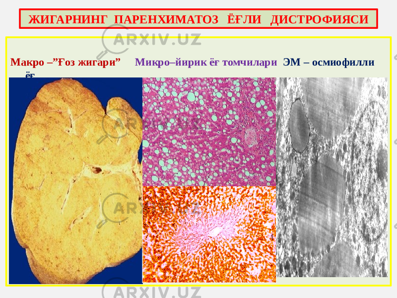 Макро –”Ғоз жигари” Микро–йирик ёғ томчилари ЭМ – осмиофилли ёғ ЖИГАРНИНГ ПАРЕНХИМАТОЗ ЁҒЛИ ДИСТРОФИЯСИ 